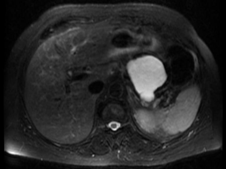 380 Brugge. Diagnosis and management of cystic lesions of the pancreas Figure 5 MRI finding of a branch-duct IPMN (BD-IPMN) at the tail of the pancreas. Note the fine septations.