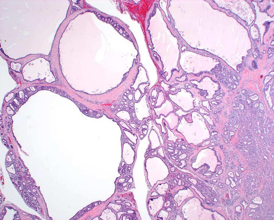 Non-papillary gastric-type mucinous epithelium (MUC5AC and/or MUC6 positive) Pathogenesis and natural course is unknown; still needs