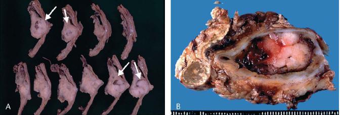 Intraductal tubular carcinoma Macro : intraductal nodules involving main duct Micro : small tubular glands, back