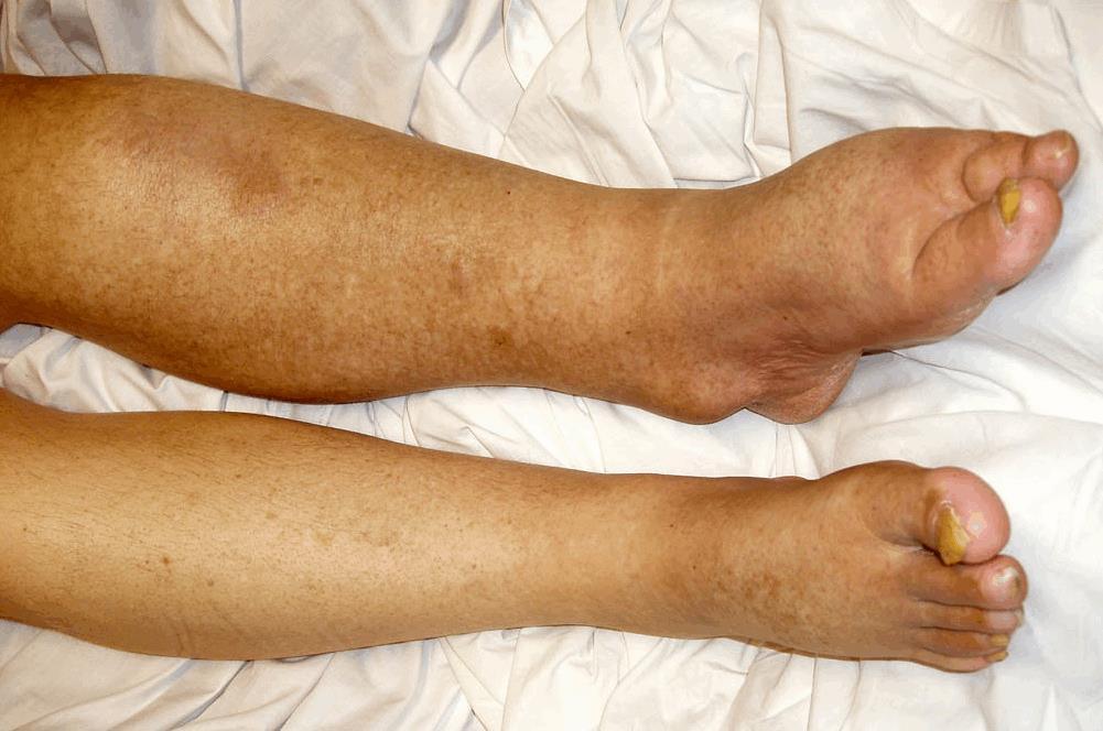 Clinical Features Edema Usually insidious in onset Resolves with leg elevation Progressive over time below the knee Aching discomfort relieved with leg
