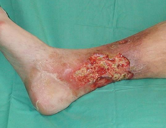Clinical Features Ulceration Trauma to legs that are compromised Fail orderly process of healing Medial malleolus most common Lateral Tibial Calf
