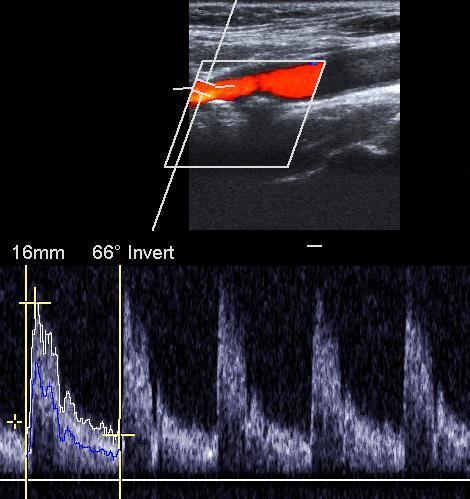 Arterial Duplex US Waveform Signals Triphasic