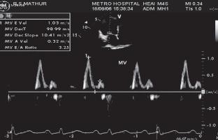 Cardiovascular Journal Volume 1, No. 2, 2009 Fig 9: Mitral Doppler in a restrictive pattern showing tall E wave and very small A wave leading to a significantly increased E/A ratio of 3.25.