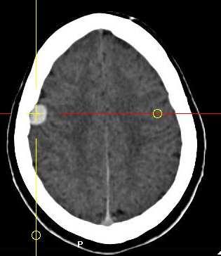 Surgery for Meningioma Is surgery required for this patient s tumor? Potential advantages of SRS Non-invasive No need for general anesthesia No recovery time Lower risk of peri-operative seizures(?