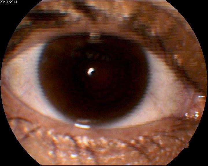 2 OCT image of the anterior segment O.D. The diagnosis was: O.U.: Angle-closure glaucoma and the patient was started on: timolol-dorzolamide drops b.d., with monthly ophthalmological assessments.
