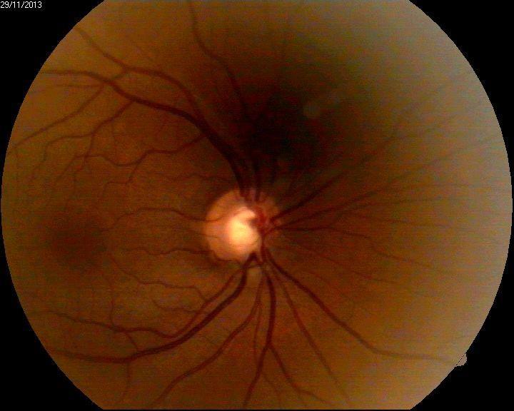 6 Fundus image of the left eye Gonioscopy: O.D.