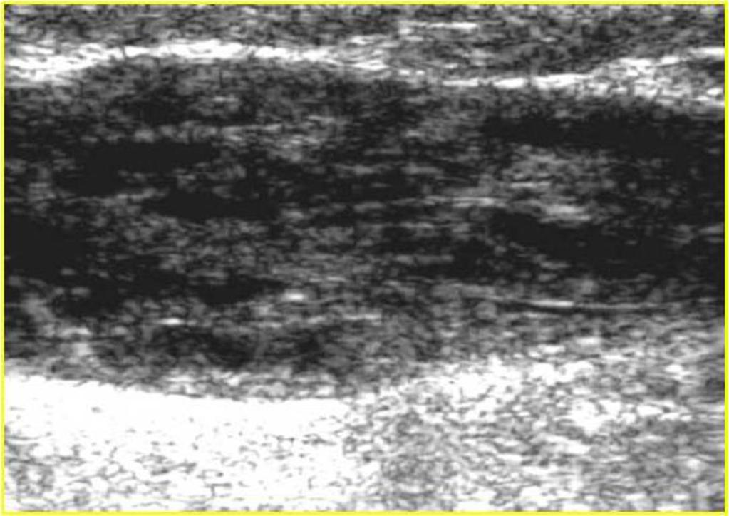 Fig. 2: Sonography: Occlusive