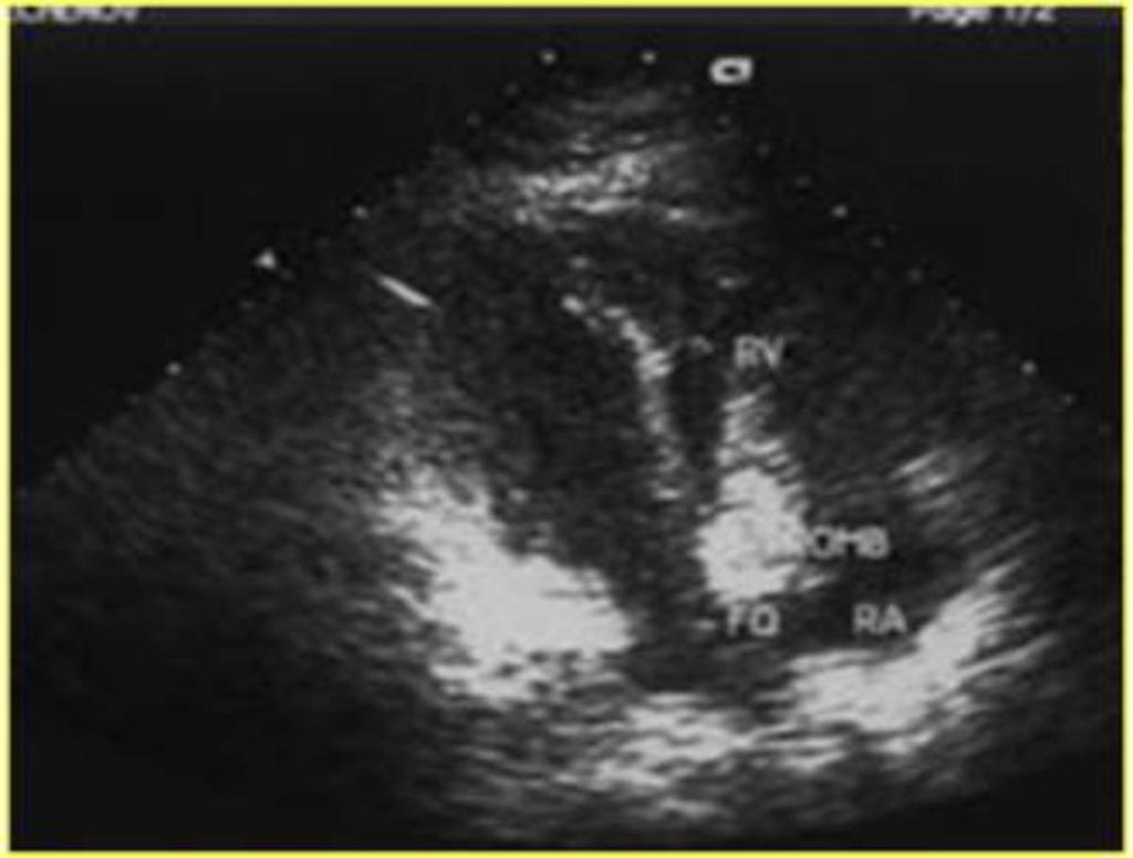 Fig. 3: Echocardiography: prolapse of thrombus