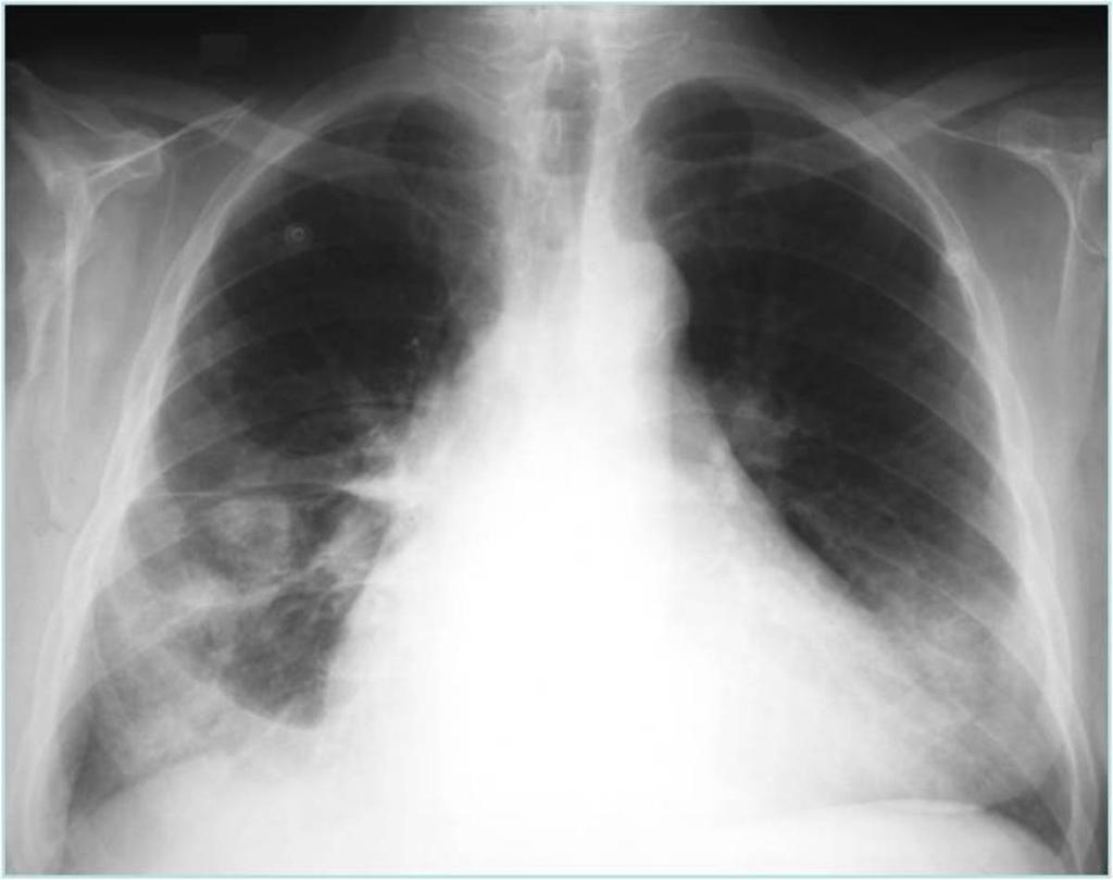 Fig. 4: Chest X-ray:subpleural infiltrat in right