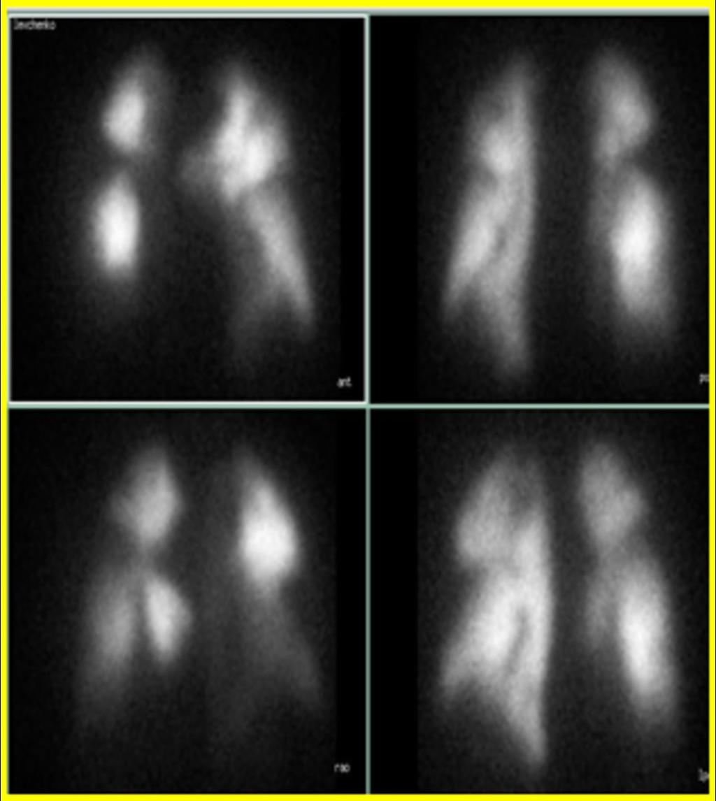 Fig. 5: Perfusion scintigraphy(99###)in patient with
