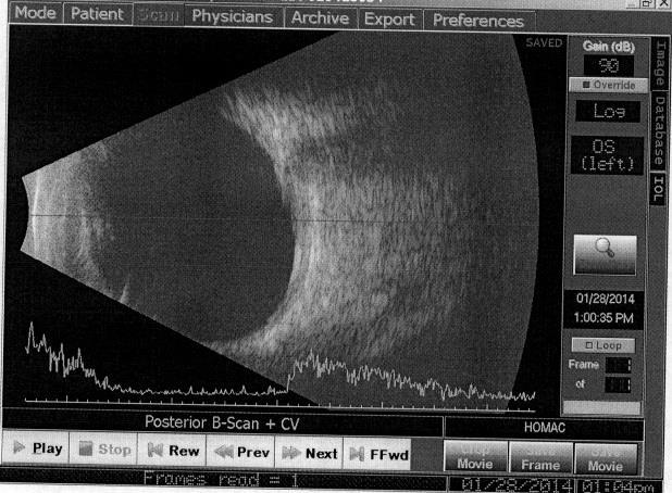 No view to fundus OS due to