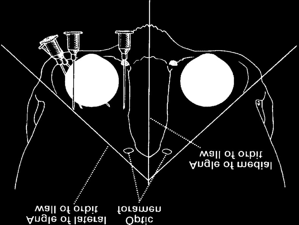 Anatomy for ophthalmic anaesthesia 81 Figure 1 Right orbit viewed from front. Figure 3 Top: frontal view of the posterior orbit of the right eye.