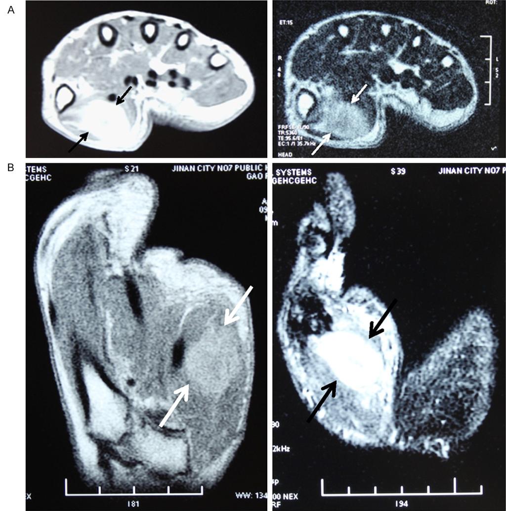 Figure 1. Magnetic resonance imaging (MRI) to the right hand revealed a well-defined enhanced mass in the right thenar muscle. A. Transverse section. B. Longitudinal section.