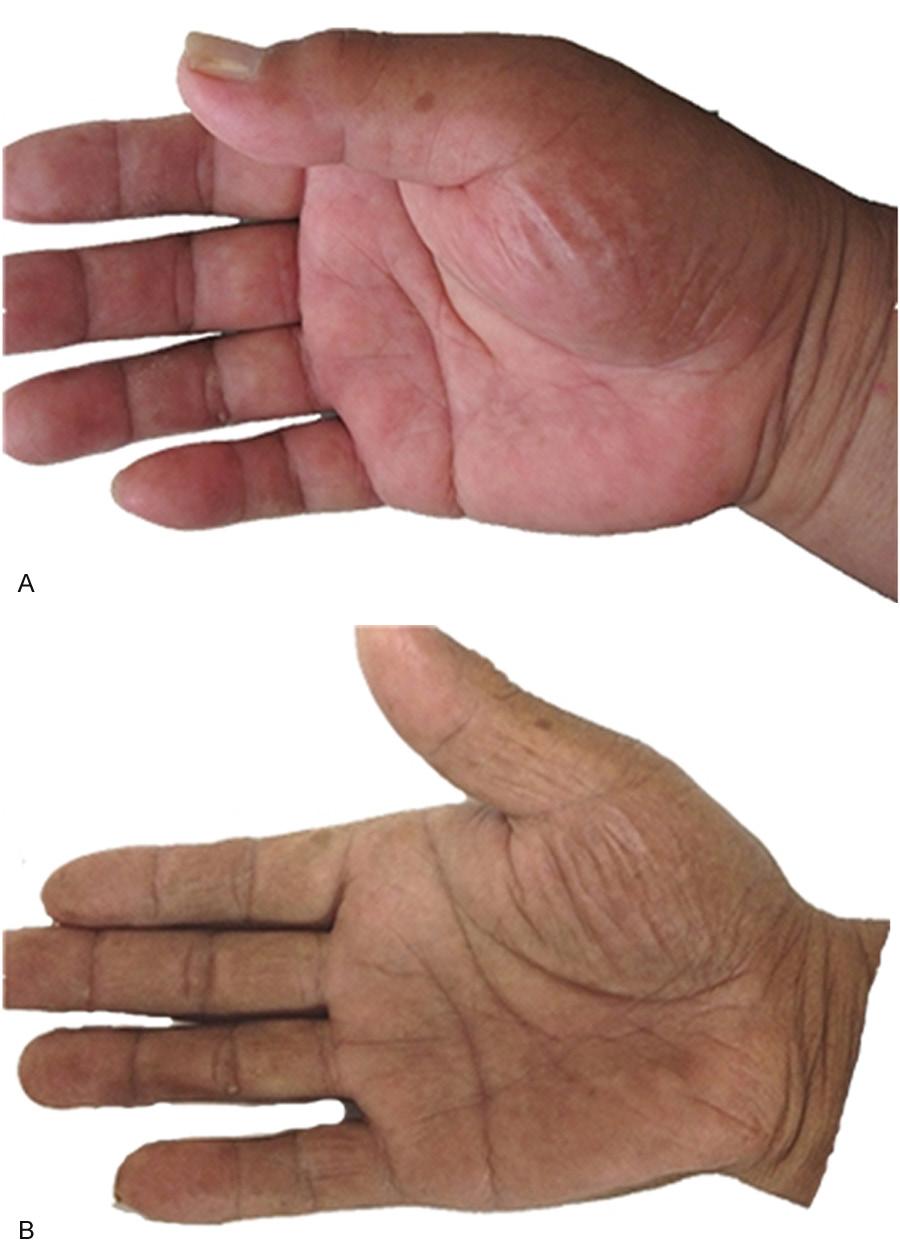 Figure 2. Physical examination of the right hand. A. Swelling of the right thenar eminence before chemotherapy, with inflammatory appearance of the right palm. B.