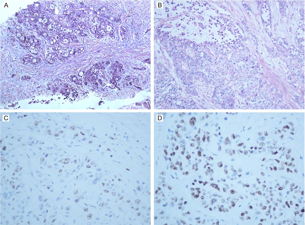Figure 3. Pathological analysis of the right hand metastasis. A. Invasive adenocarcinoma in the background of connective tissue was demonstrated in the biopsy of thenar (HE stain, 100); B.