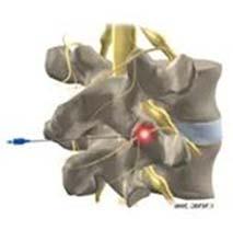 Photonic Needle Optical tissue characterization in pain management Fiber Optical Shape Sensing and