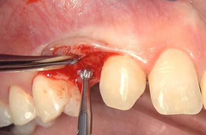 Fig. 6: Using a 4-mm punch, the mucosa in region 13 was precisely shaped around the implant base.