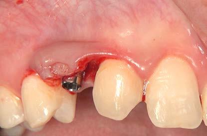 8: Individual button sutures were used to suture the minimally invasive incision around the gingiva former inserted into the implant base. Fig.