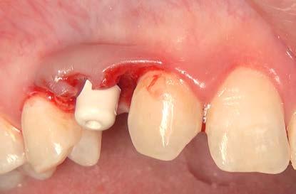 4 mm / L 11 mm with the premounted implant bases that bear the PEEK gingiva removed using a slightly larger punch. formers. palatal flap not detached.