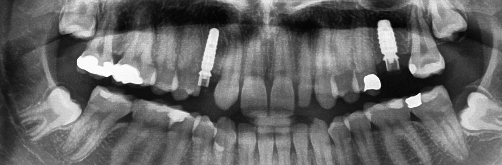 At the time of the implantation, a wide gingiva former was not yet supplied with the isy System which was why a punch was also used here that had a