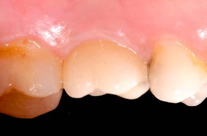 Crestal bone loss and the consequences of retained excess cement around dental implants. Compend Contin Educ Dent. 2012 b;33(2):94-6, 98-101. AUTHOR Dr. Maximilian Blume Contact information Dr. med.