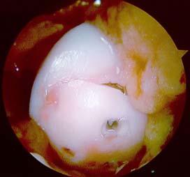 Imaging of Cartilage Repair Carl S.