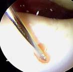 Drilling Microfracture Johnson, Clin Orthop