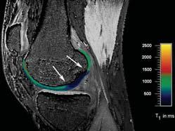 J Magn Reson Imaging 2007;26:974-82 Usefulness of MR in Evaluation of Cartilage Repair What is the cause of symptoms?
