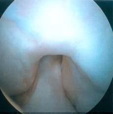 MD BWH Cartilage Repair