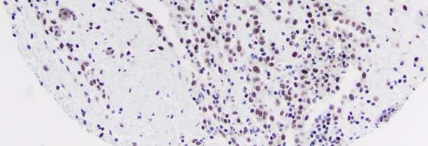 Mesothelioma Chromosome 9