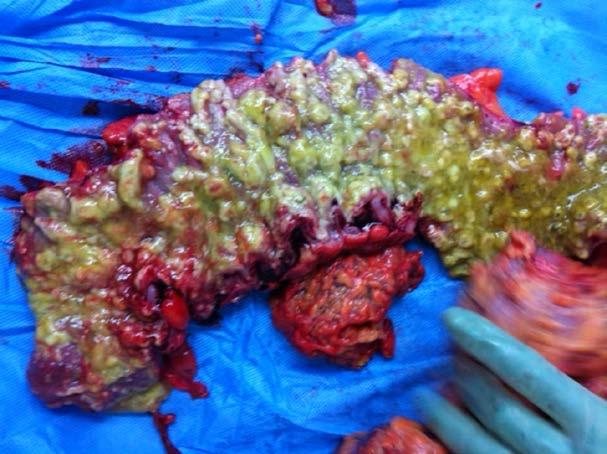 New surgical approach for fulminant colitis- less invasive, better mortality