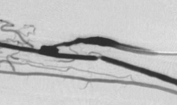 Arterial Stenoses juxta-anastomotic stenosis cephalic