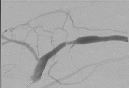 flow from primary outflow vein Thereby inhibits maturation of fistula Failure to