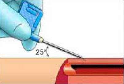 Reality: Needle Angulation Some fistulae are very shallow and a shallow angle should be used.