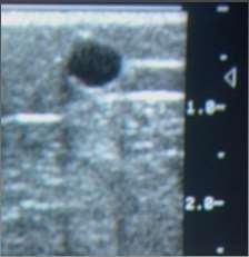 Ultrasound can be used to improve initial