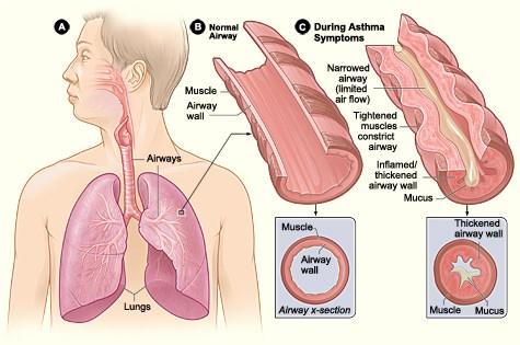 Pathophysiology Bronchospasm Airway hyper-responsiveness Airway edema (chronic