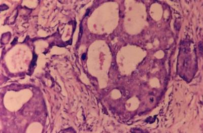 3] Figure 3 Fig. 3:- Salivary duct carcinoma cut section grey-white homogeneous surface with foci of necrosis and tiny cystic spaces.