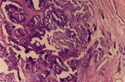 There have been several reports describing the cytological features of salivary duct carcinoma; however accurate diagnosis by FNAC can still be
