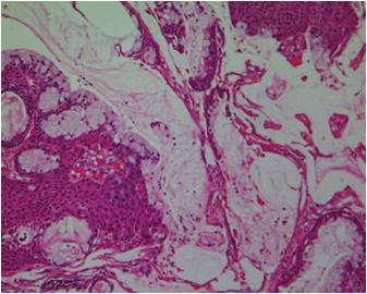 2b. Myoepithelioma showing hyaline