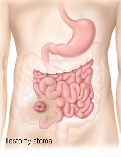 The position of the ostomy in relation to the bowel will dictate the consistency of the waste matter.