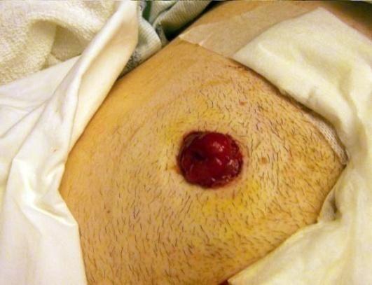 Colostomy Stomas A colostomy is a surgical procedure in which a stoma is formed by drawing the healthy end of the large intestine or colon through an incision in the abdominal wall and suturing it