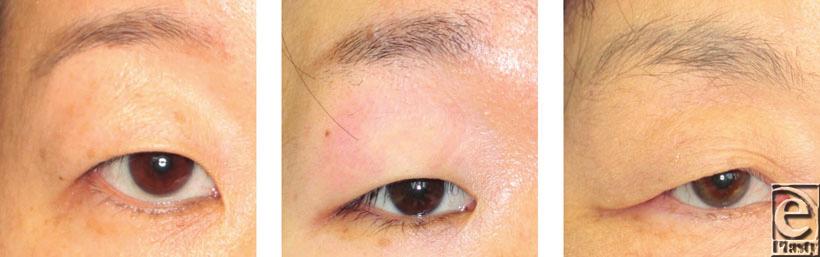 Eyes with suspected ptosis in which the MRD narrowed to less than 1.