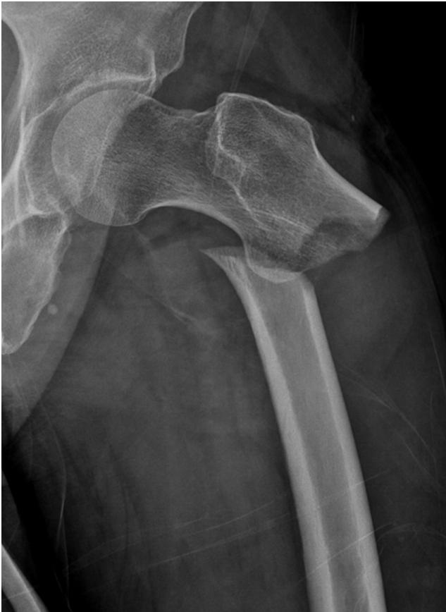 Atypical Femoral Fractures Fig. 1. Sixty-eight-year-old woman with left hip pain. In initial radiograph (left side), there is cortical thickening of lateral cortex of left femur subtrochanter area.