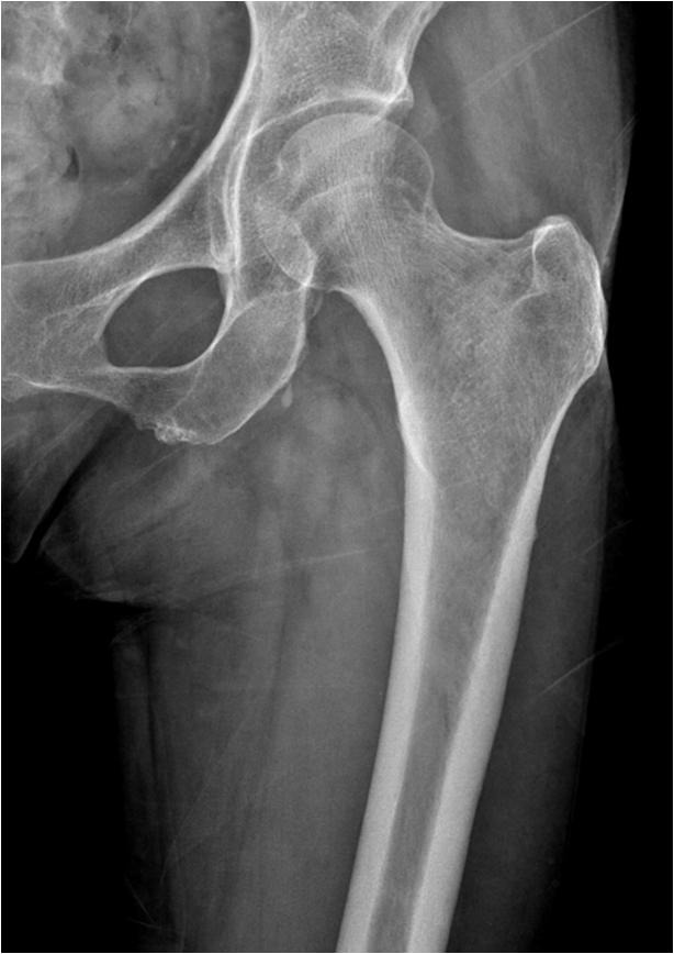 The American Society for Bone and Mineral Research task force 2013 revised case definition of atypical femoral fractures Major features The fracture is associated with minimal or no trauma, as in a