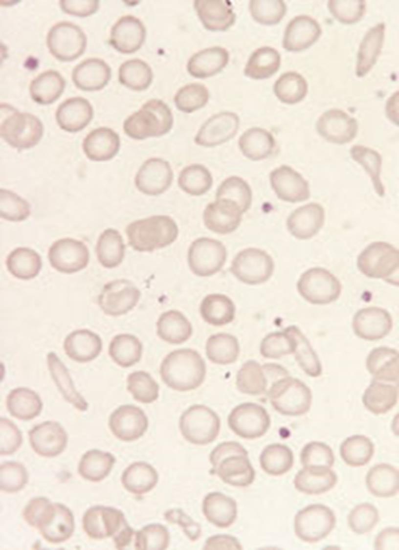 Classification of anaemia By Underlying Cause Decreased Production Increased
