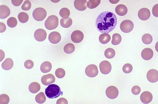 Anaemia-macrocytic (enlarged red cells) MCV > 100fl B12 / folate deficiency Excessive alcohol intake (chronic) High red