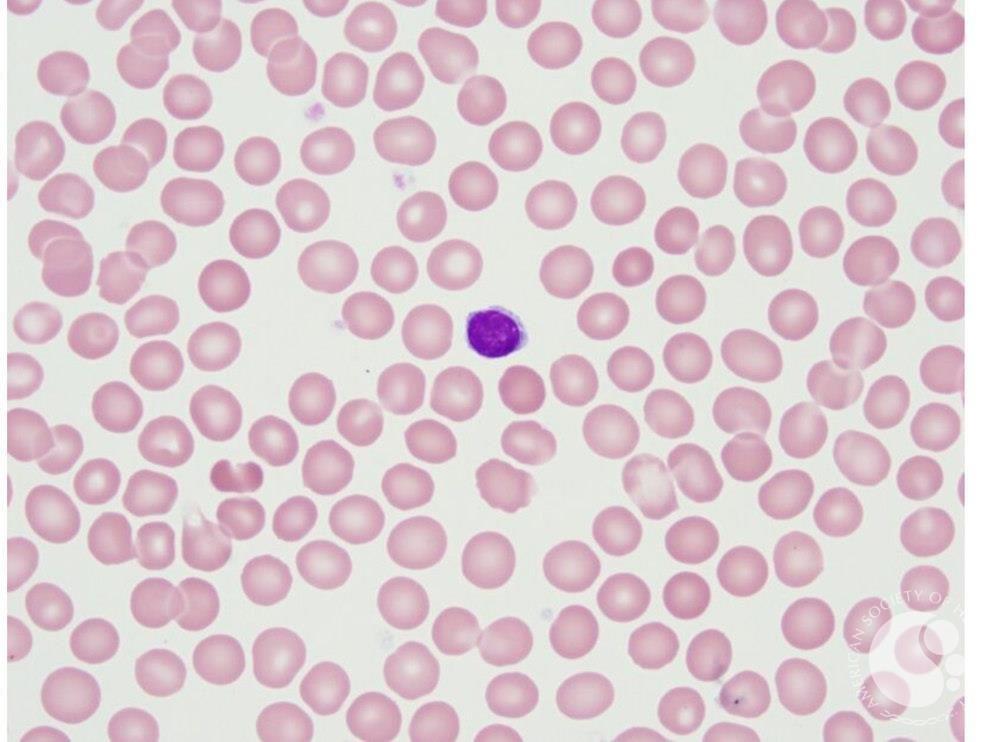 Anaemia-normocytic (red cell size normal on average) MCV 85-100fl Can happen with any of the previous causes