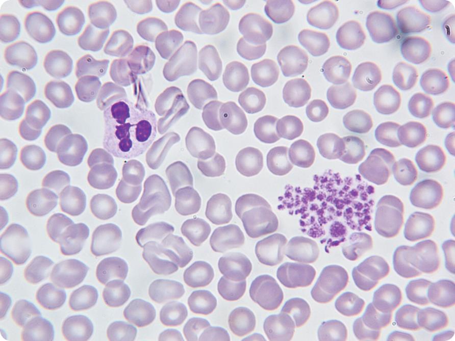 Pseudothrombocytopenia or spurious thrombocytopenia is an in-vitro sampling problem which may mislead the diagnosis towards the more critical condition of