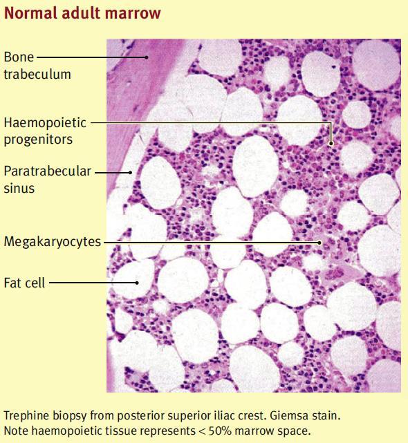 Adult Bone Marrow Axial (Central) Skeleton 30% of active marrow sites are haemopoietic (red marrow) Remainder = yellow marrow (fat cells) Chronic haemolytic anaemia Increased cellularity in bone