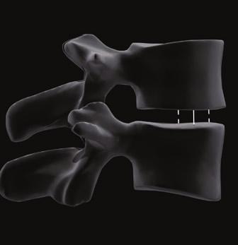 Visualization Each AVS ARIA implant has seven tantalum markers strategically embedded in each implant to help surgeons identify the position and orientation of the AVS ARIA implants once inserted.